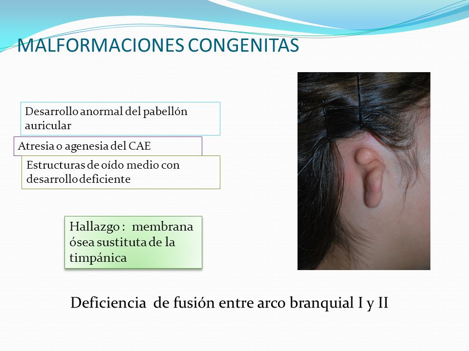 agenesia de pabellón auricular
